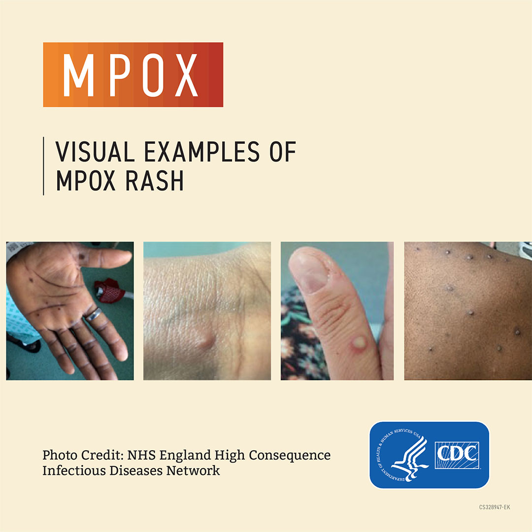 visual examples of mpox rash