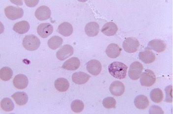 Plasmodium vivax parasite infection in human blood sample