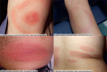 Common appearances of Erythema migrans